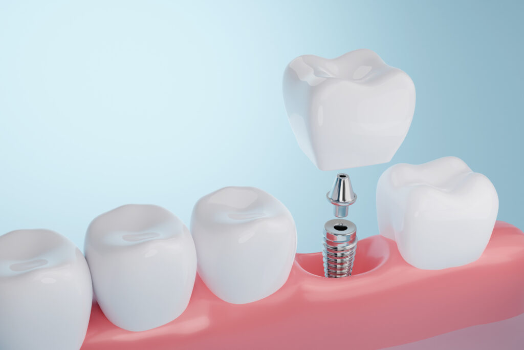 Dental Implant Illustration