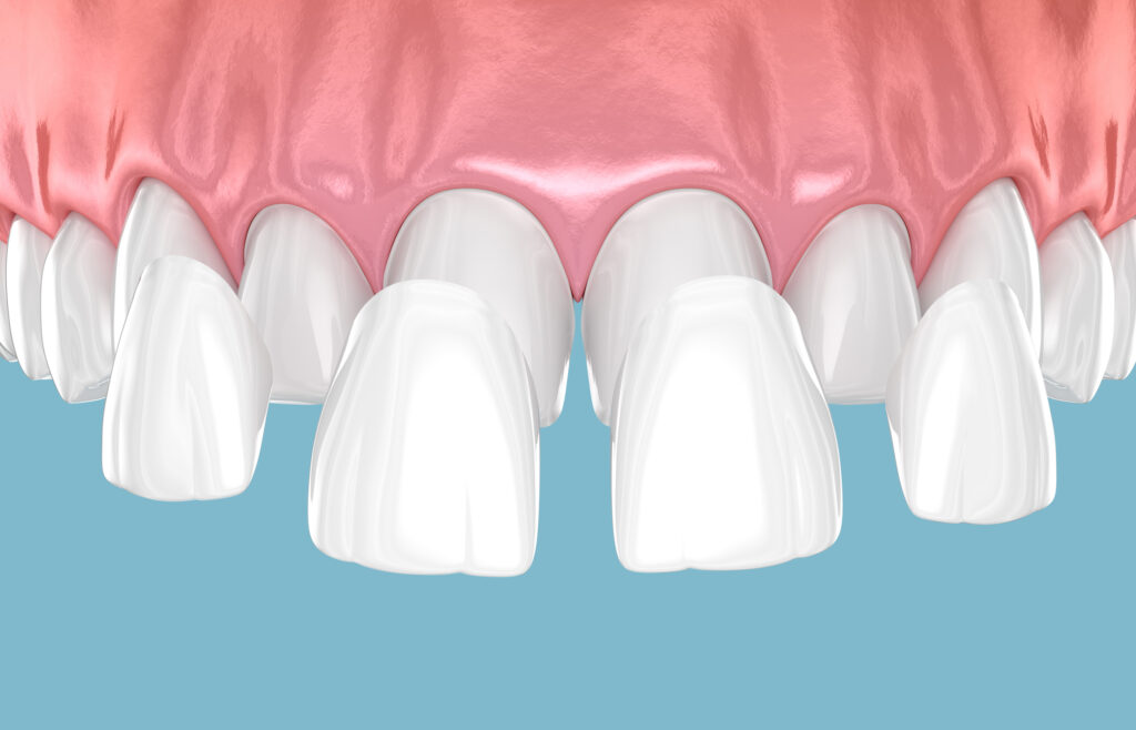 Dental veneer placement over frontal teeth. 3D illustration