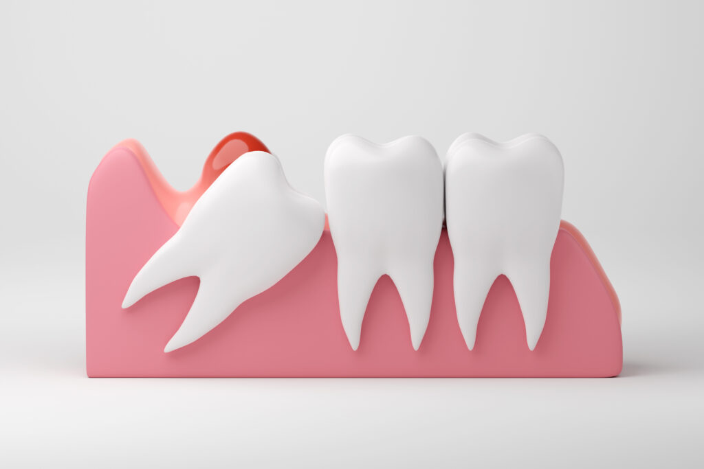 Impacted Wisdom Tooth Illustration