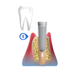 dental implant placement in plano