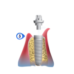 implant placement dental preston meadow plano