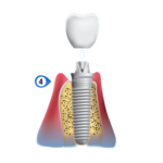 implant placement dental preston meadow plano
