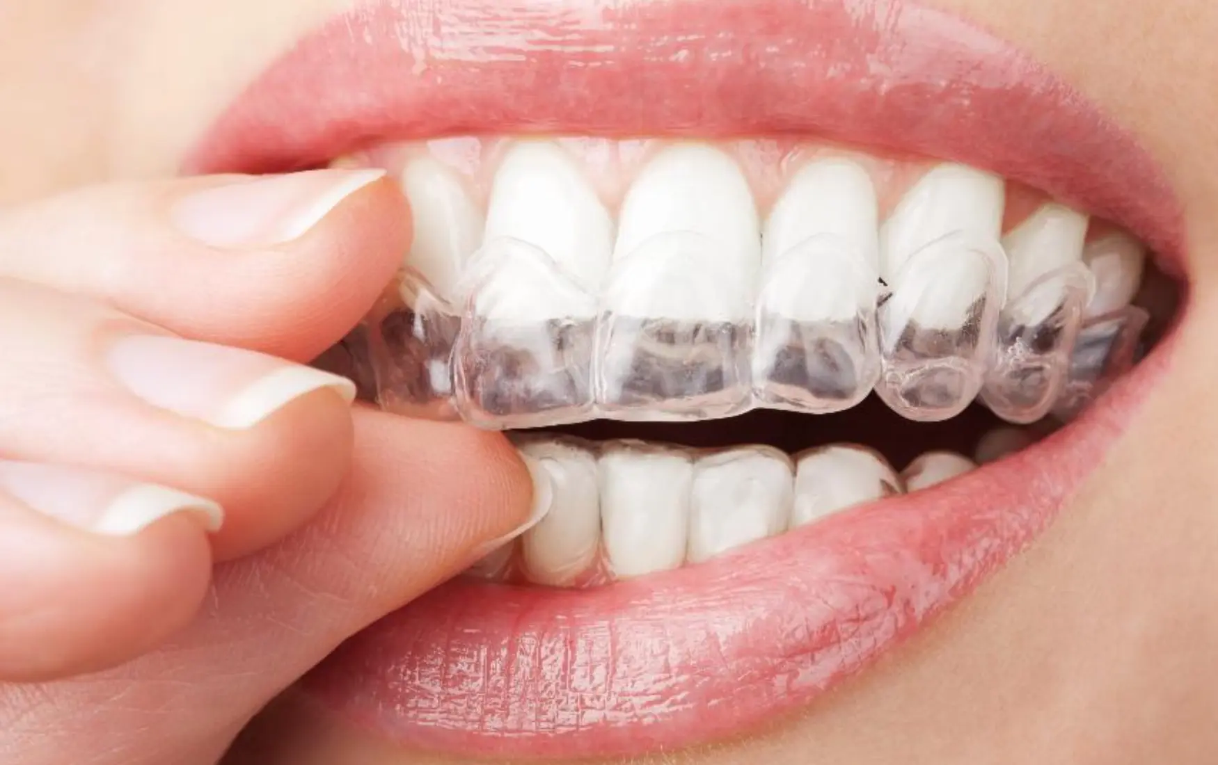 Clear Aligners Plano Candid Pro Invisalign