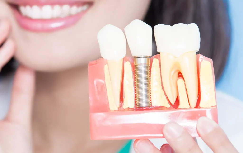Dental Implants Plano Dentist Near Me