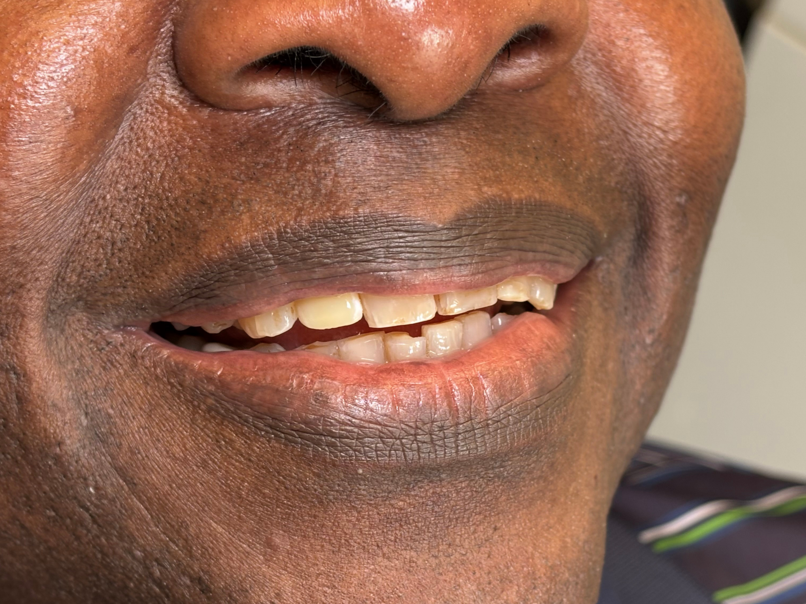 Plano Dentist before and after dental implants, Preston Meadow Family Dentistry