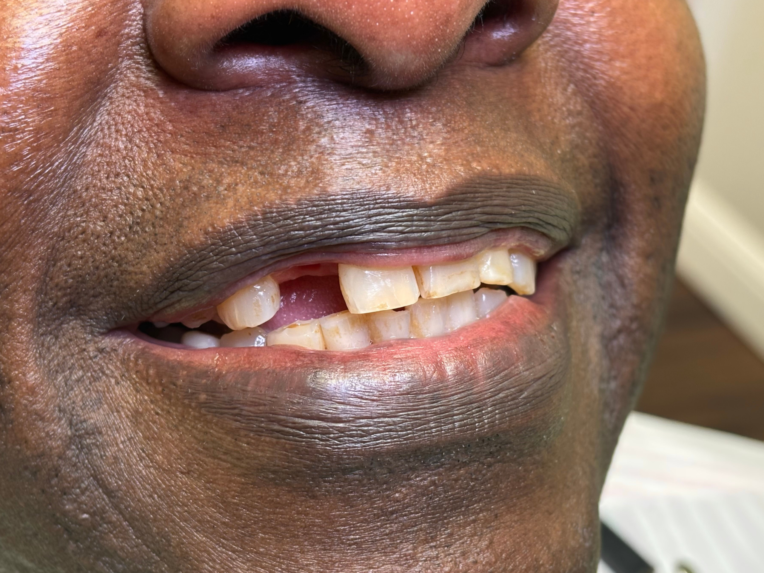 Implants before and after